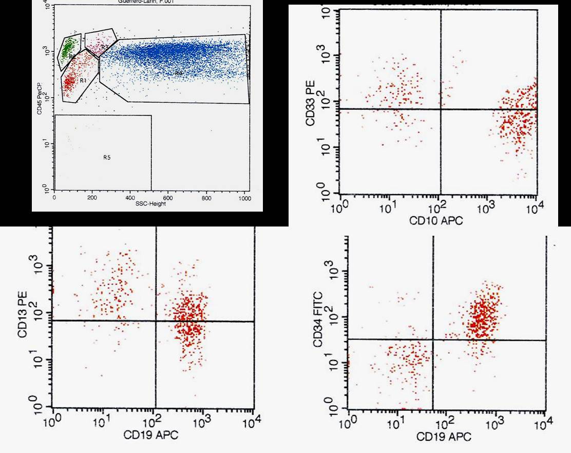 Figure 7) Flow cytometry dot plots showing a population of B-lymphoblasts (red) with expression of CD34, CD19, CD10, and aberrant expression of CD13 and CD33